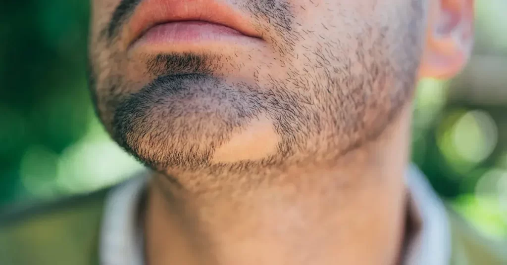 Bald patch in beard