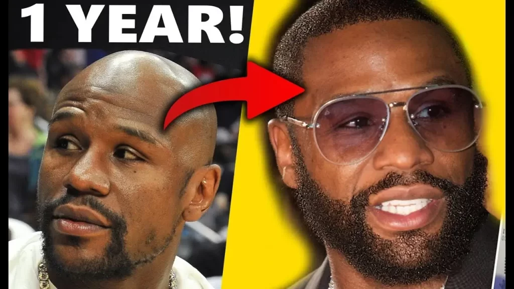 Floyd Mayweather beard transplant