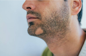 How much beard hair loss is normal