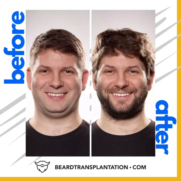 beard transplant before and after image