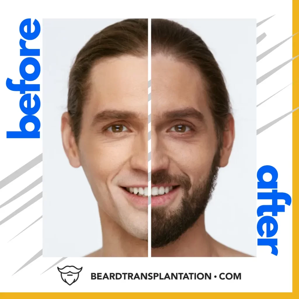 before and after beard transplant comparison